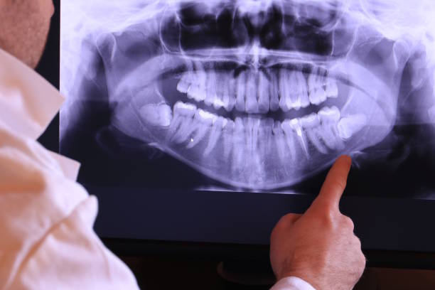 Best Emergency Wisdom Teeth Removal in Wlow Springs, IL